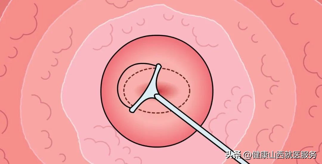 *裤内**上出现这东西,可能是宫颈癌前兆!千万别拖,尽早做两个检查