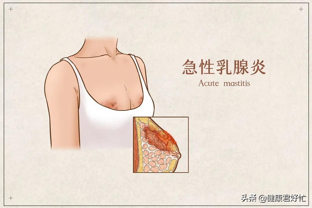 急性乳腺炎的一般疗法有哪些,急性乳腺炎西医治法
