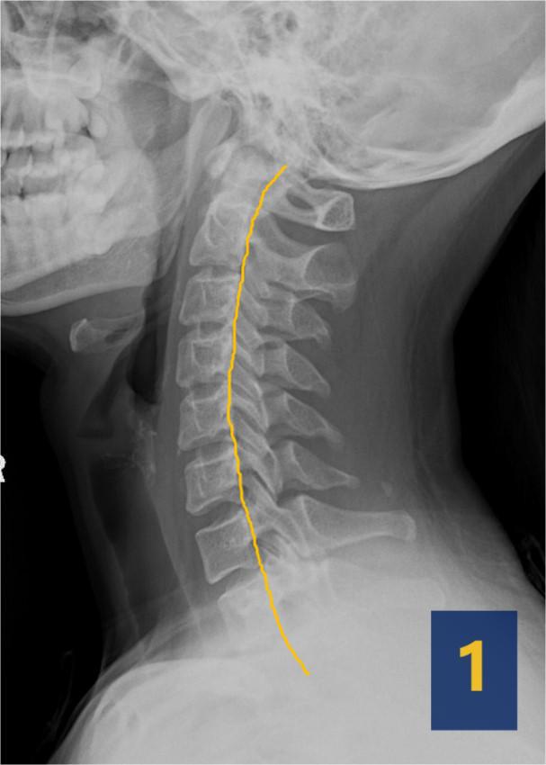 颈椎x线片可以看出颈椎病吗,x线片脊椎左右怎么看
