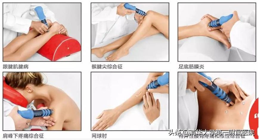 它来了！缓解腱鞘炎、网球肘、筋膜炎的“神器”