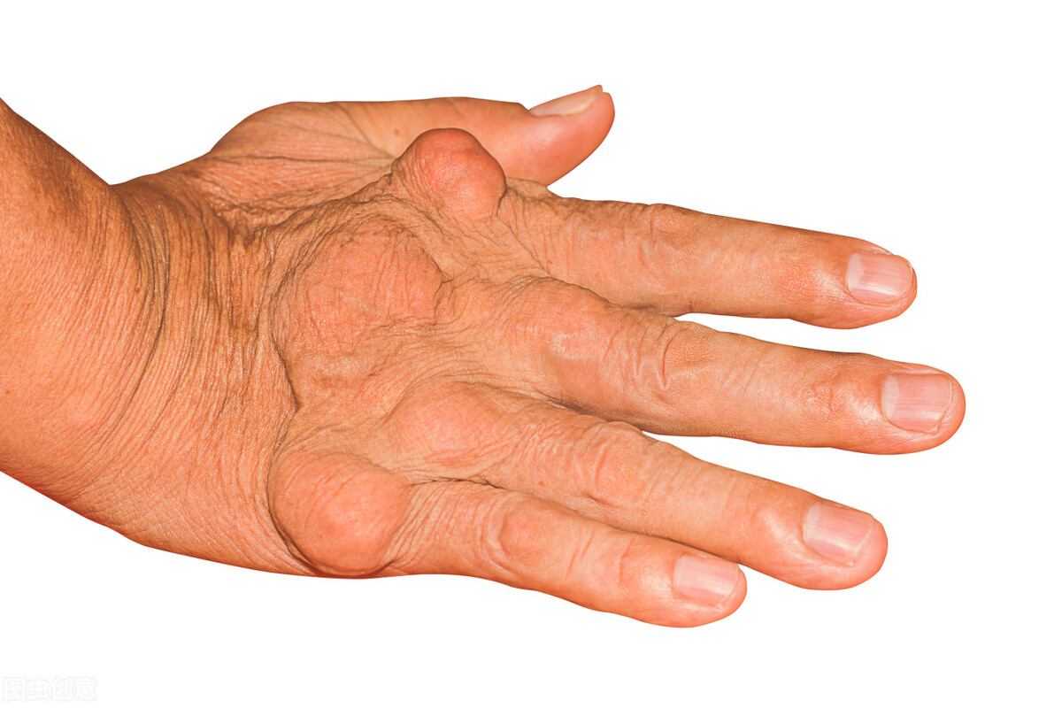 哪些药能排尿酸或阻止尿酸合成,降尿酸和排尿酸最好的药