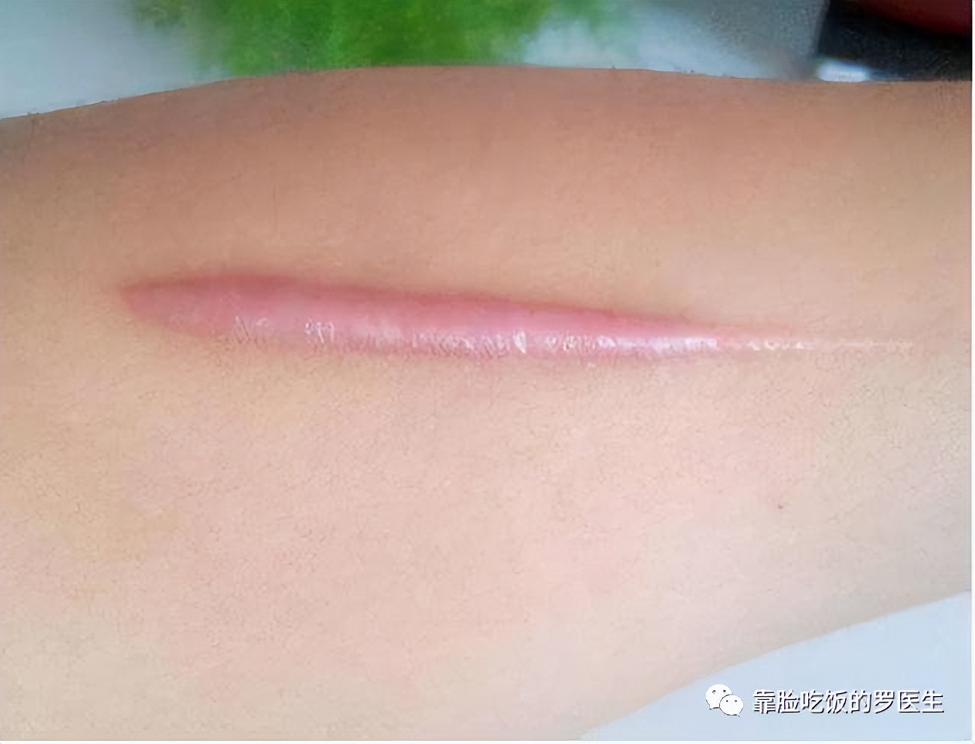 科普疤痕知多少,瘢痕科普视频