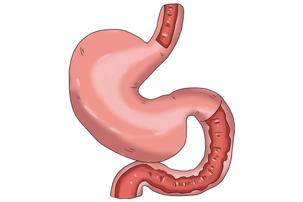 全球胃癌发病率排行,日本胃癌为什么高发