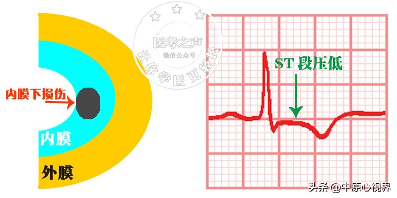 护考几种常见的心电图,常见的心电图图形分析