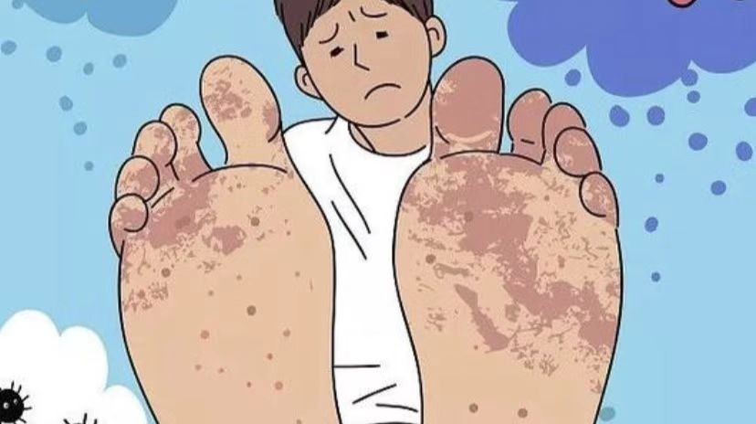 真菌感染怎么预防,足部真菌感染怎么解决