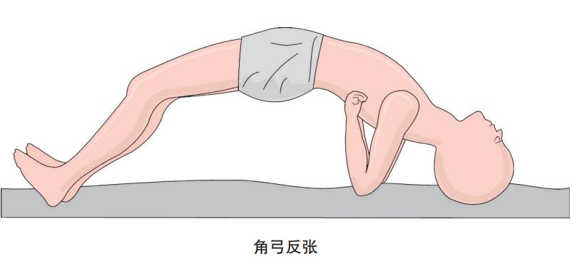 破伤风感染条件防治原则,简述破伤风的致病条件及防治方法