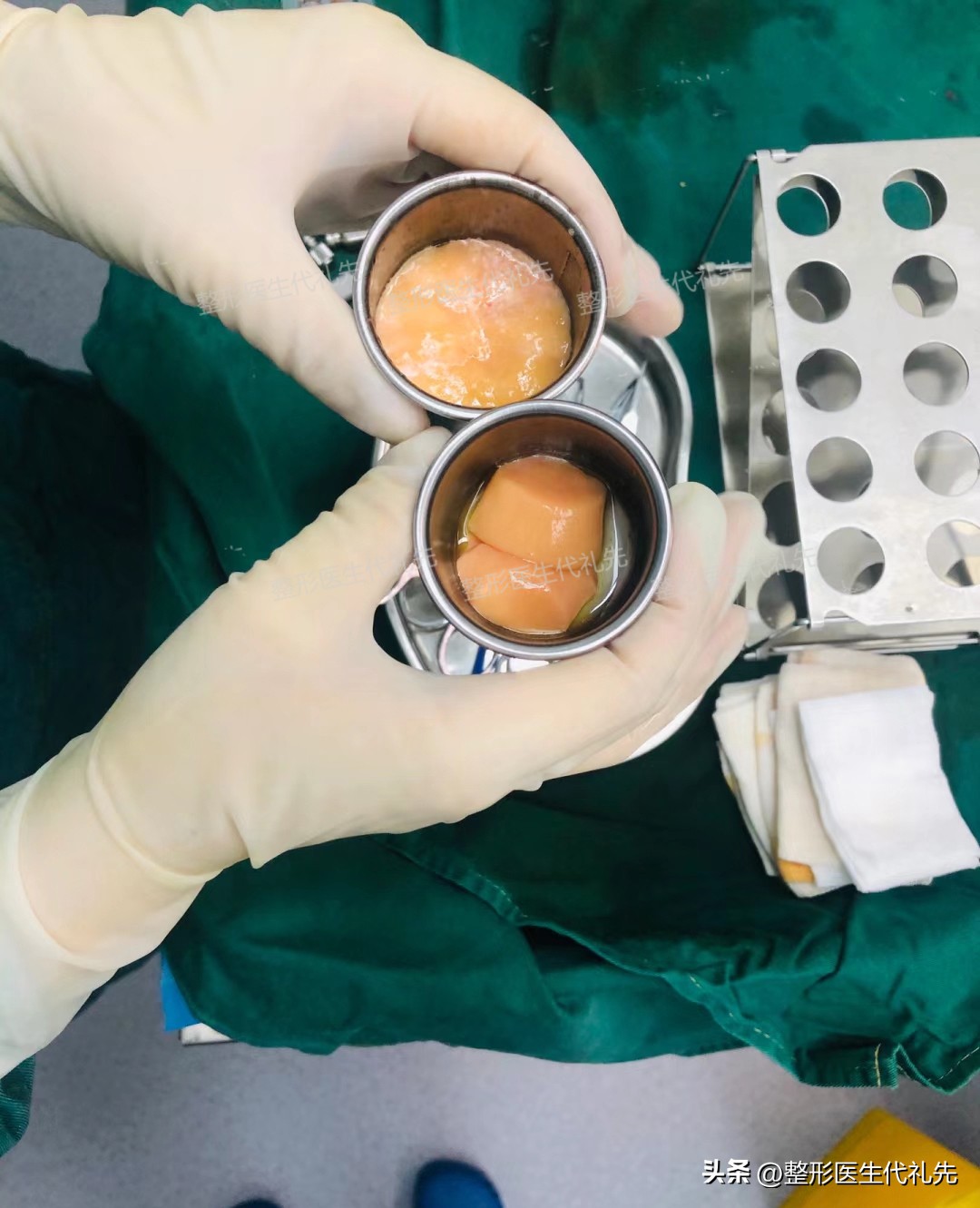 面颊凹陷填充会改善法令纹吗,面颊凹陷下垂如何填充