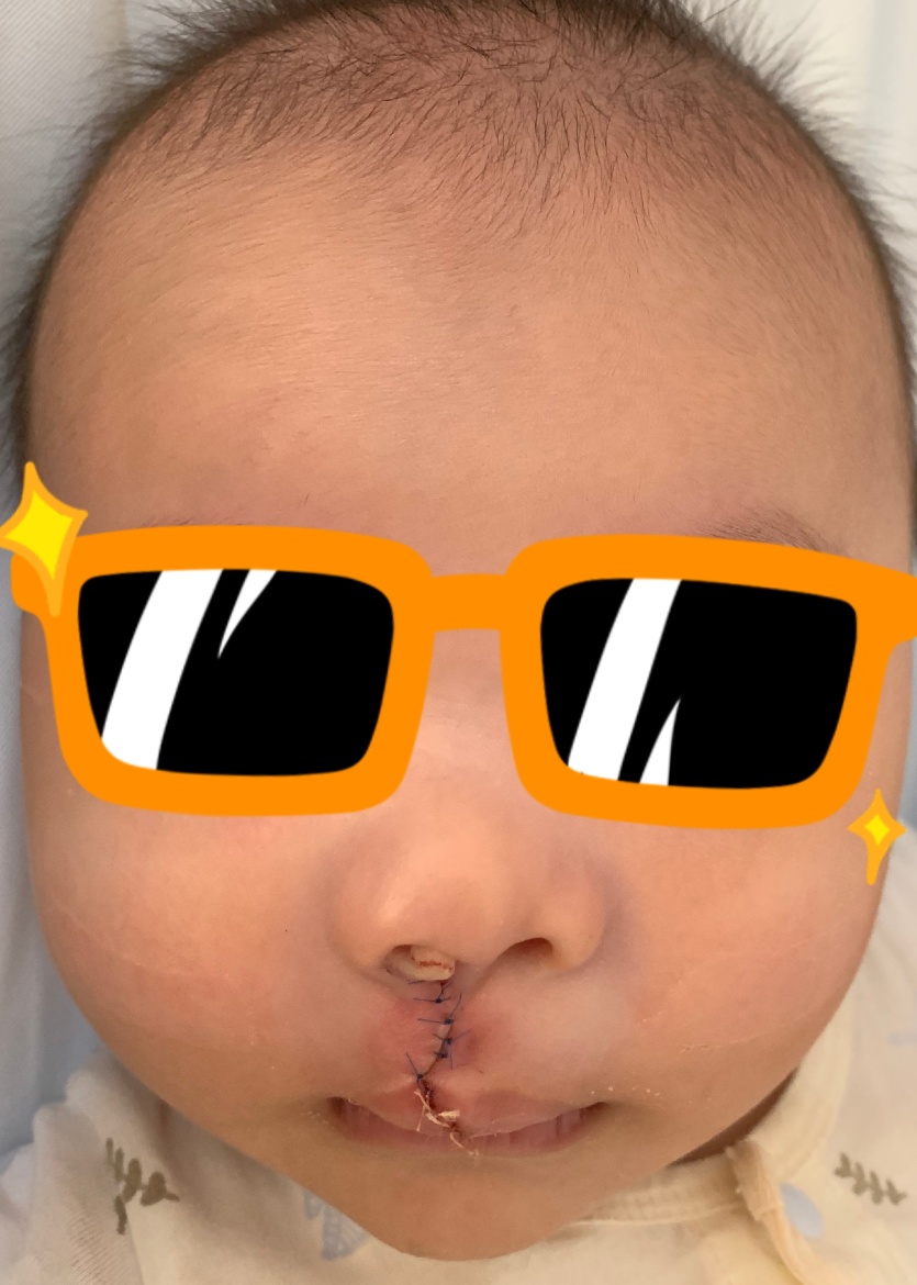 宝宝是一只“小兔子”，还没长牙就要开始正畸了