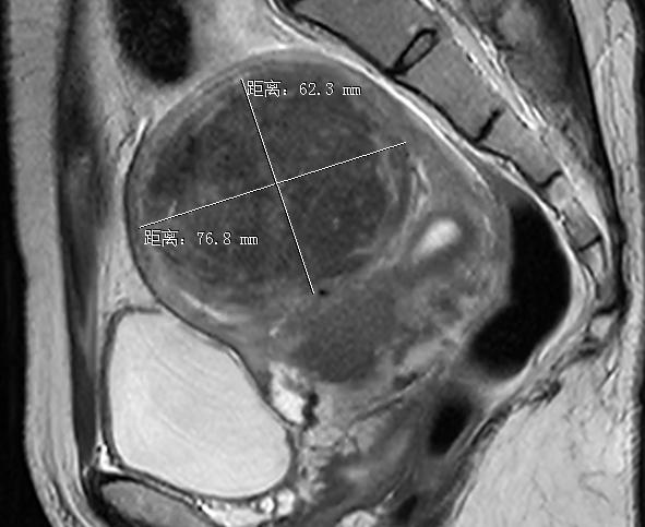 子宫肌瘤海扶刀301医院,子宫肌瘤海扶刀治疗后再次手术