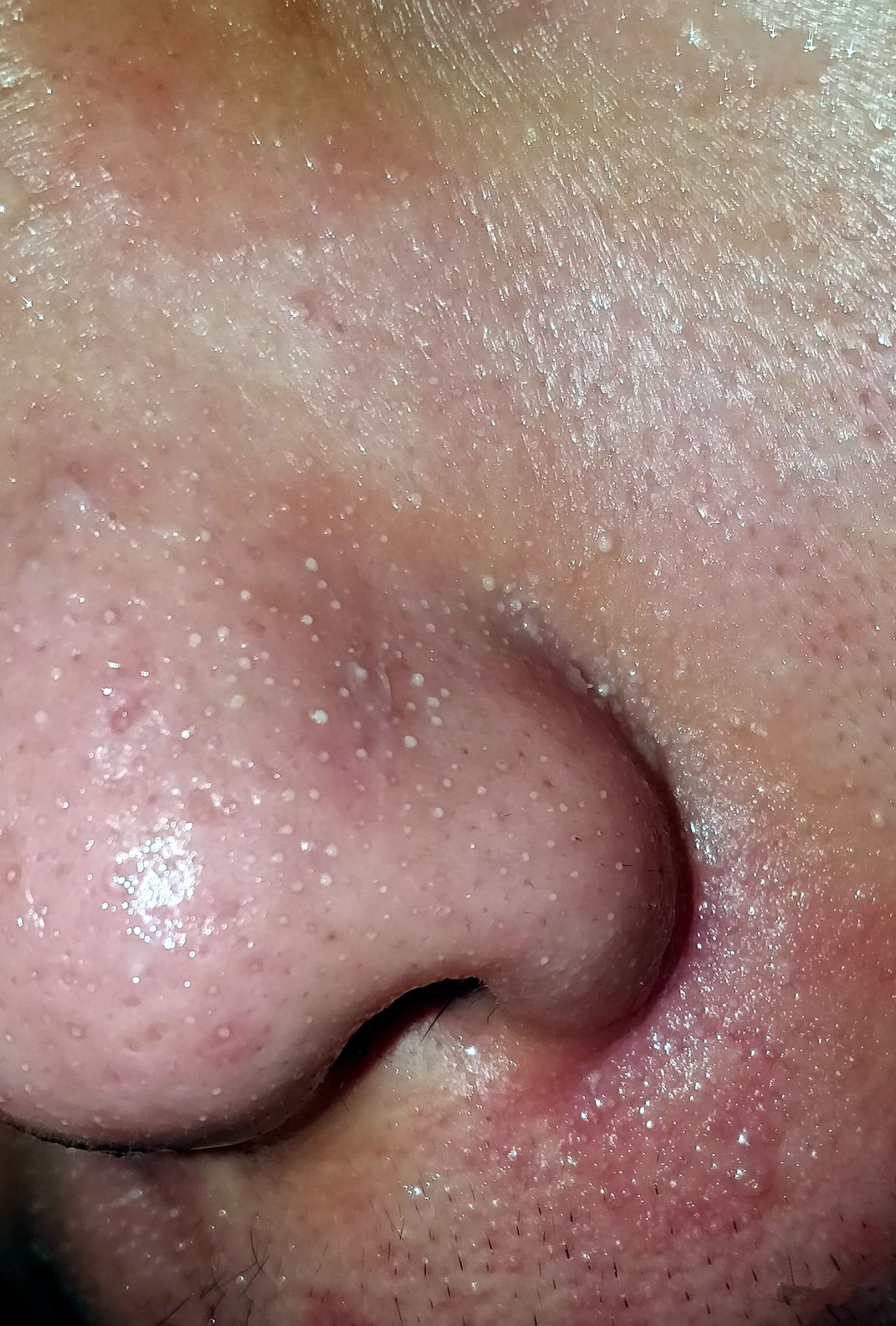 额头眉心发红有闭口粉刺,眉心鼻头频繁起粉刺怎么办