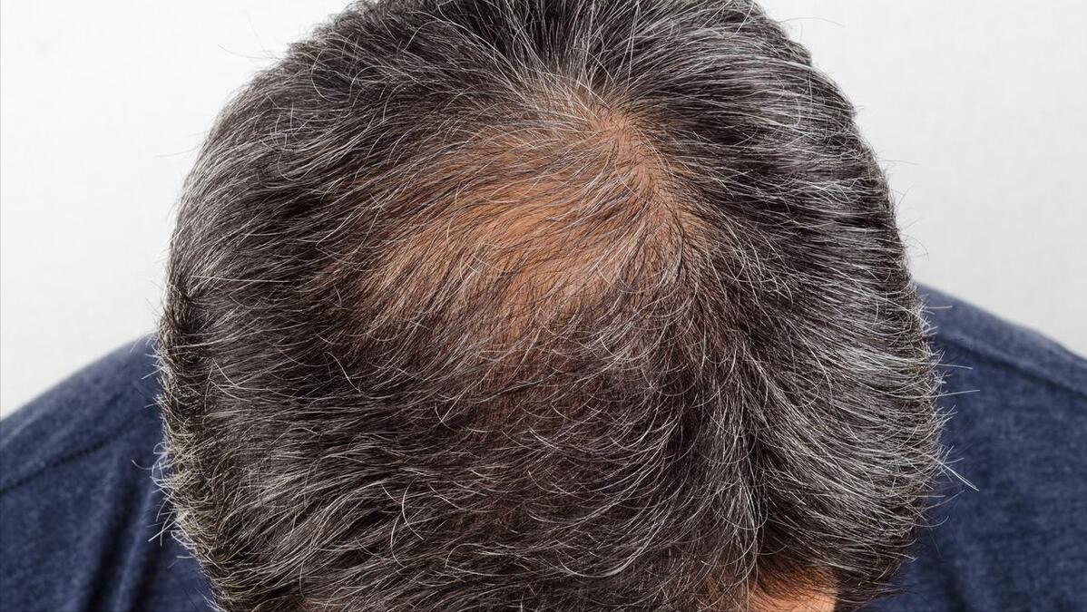 肝肾不足型脱发中药,脱发乌发经方