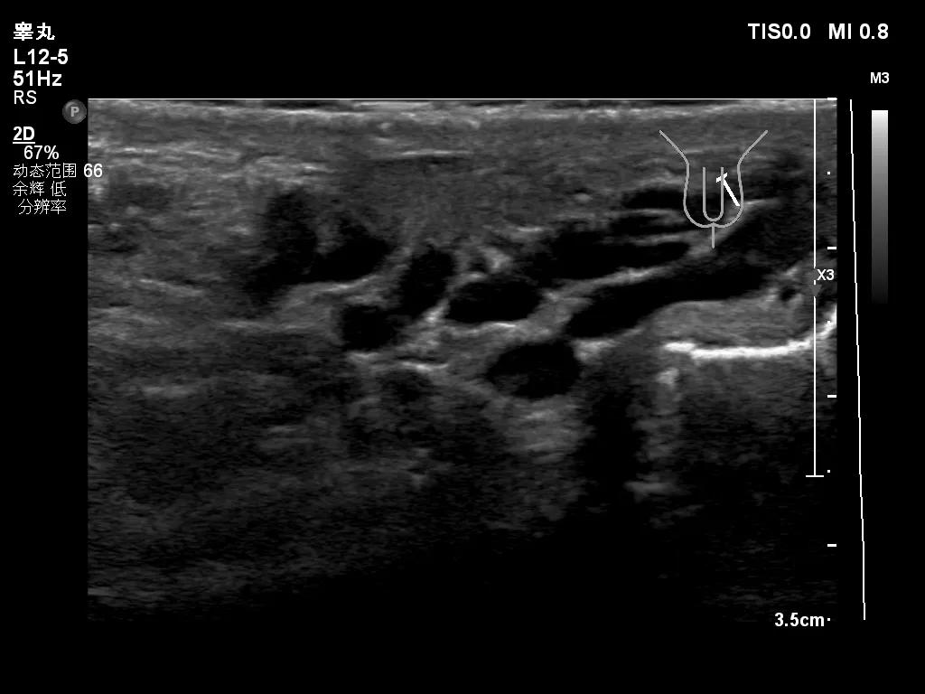 男人小腹胀下坠是什么原因,睾丸坐久隐痛是为什么