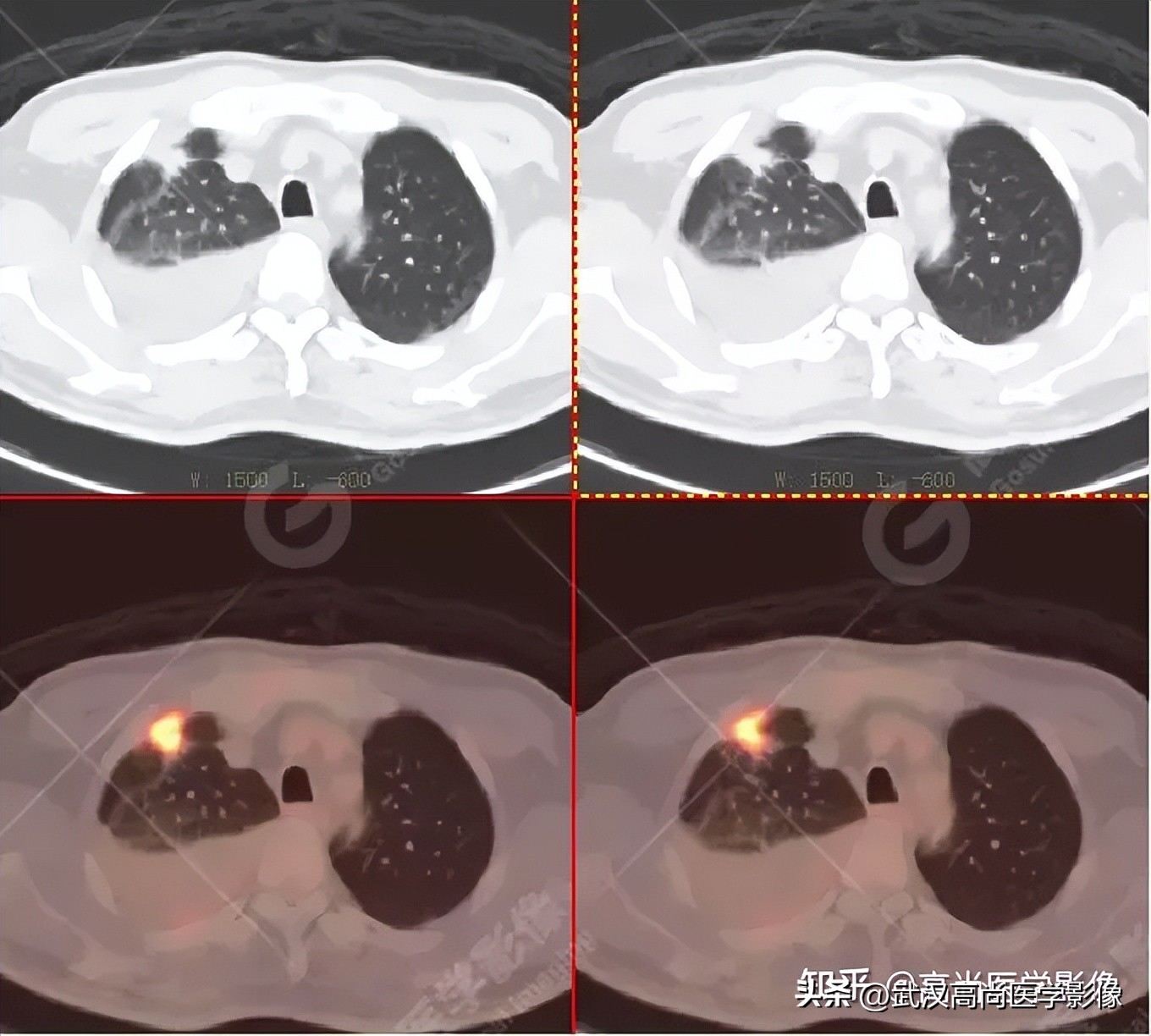 10毫米的肺结节恶性死亡率有多大,1厘米多的肺结节良性可能性多大