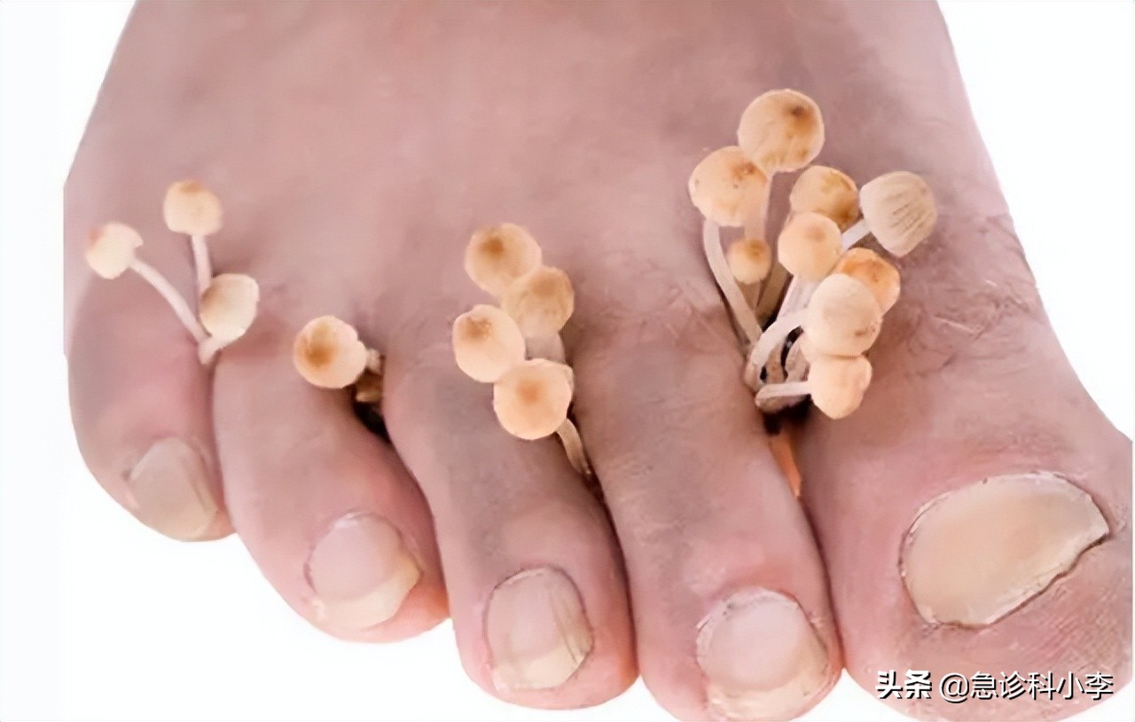 脚气反反复复怎么办？医生：教你2个实用方法，根治脚气不复发