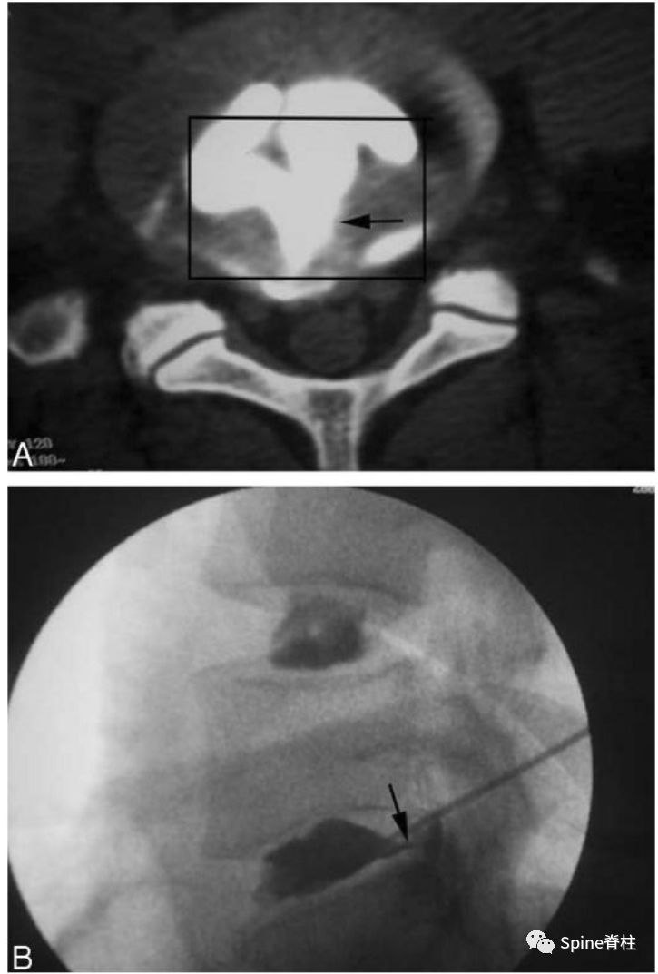 因腰椎问题导致的腰痛,慢性腰骶部疼痛