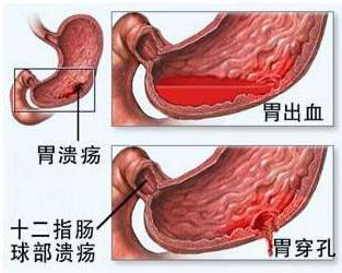 胃出血一般是什么引起的,胃出血严重吗有哪些危害