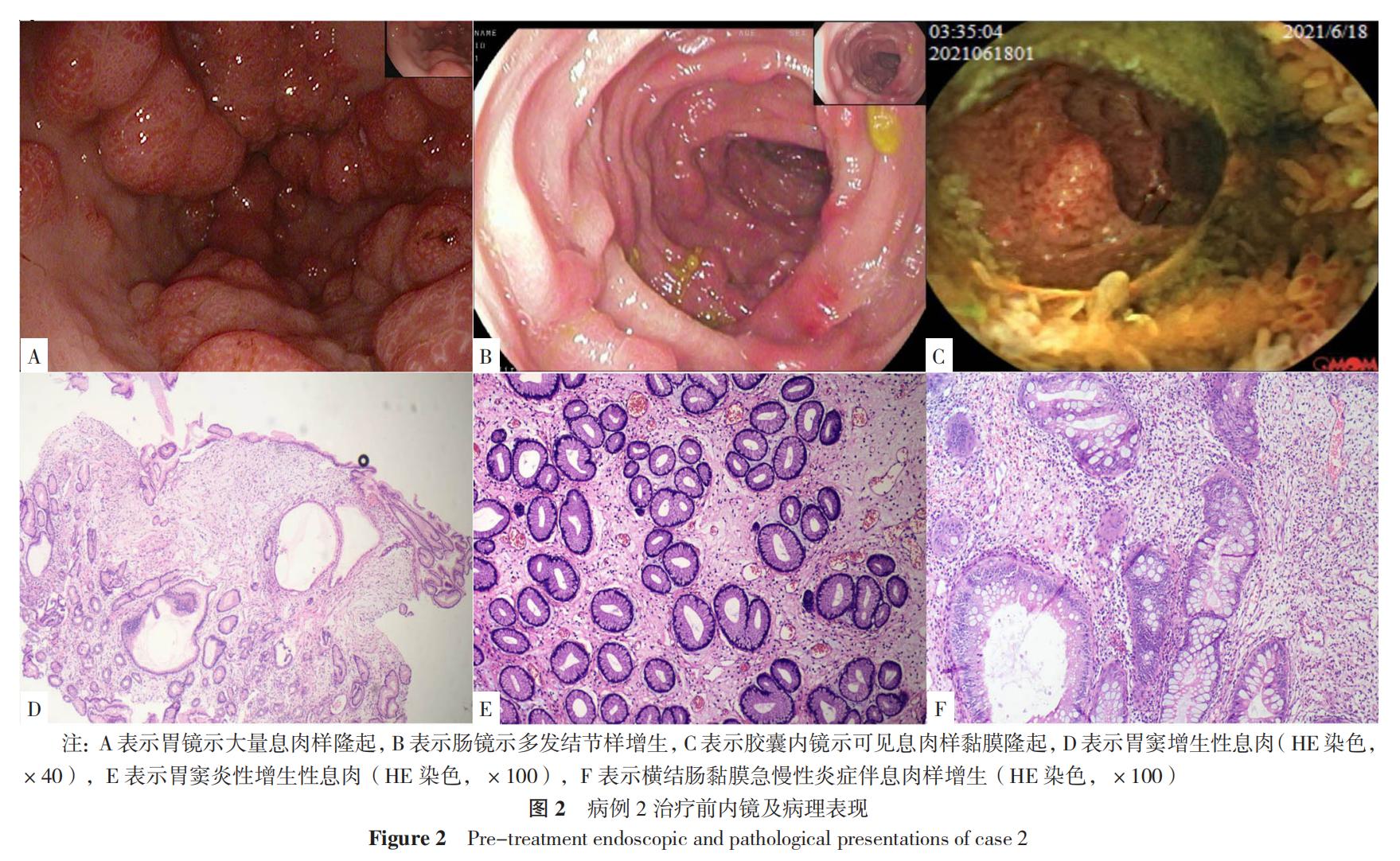 cronkhite-canada综合征能治愈吗 (cronkhite-canada综合征)