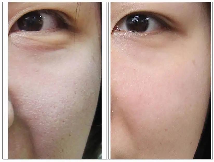 皮秒缩毛孔恢复过程图,去油缩毛孔最好的方法