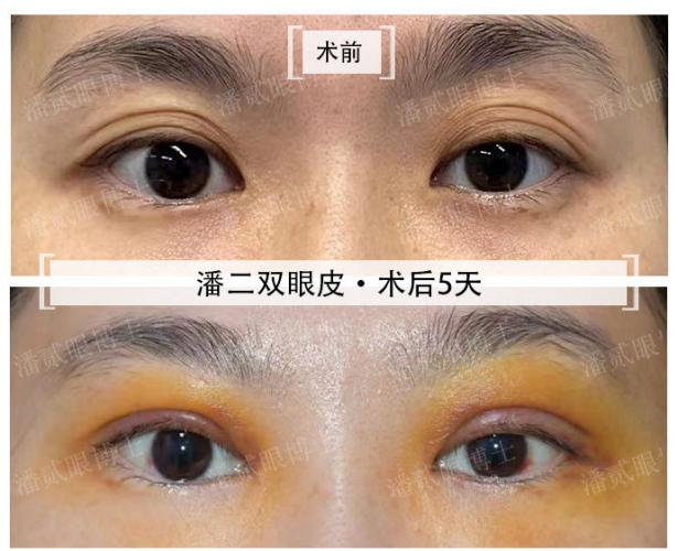 整形双眼皮失败案例,广州宝妈产后修复