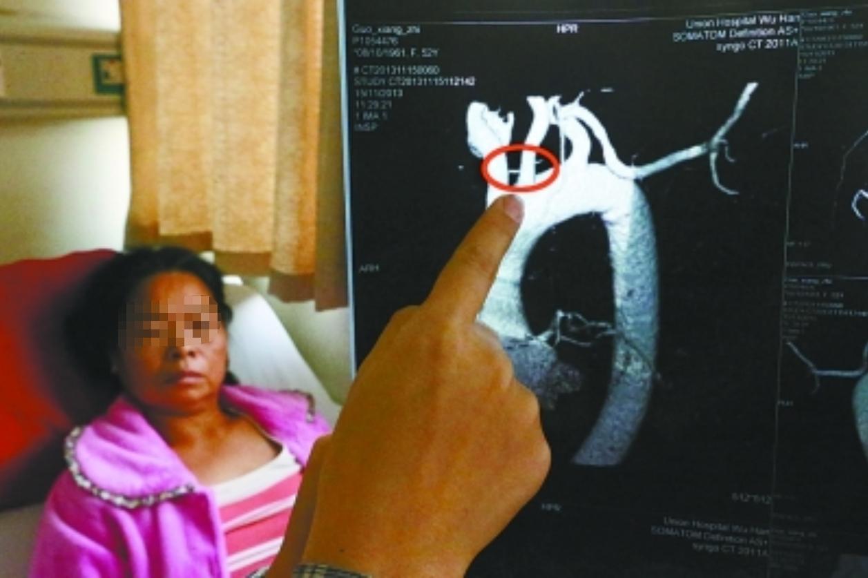 2010年,厦门小伙连续3月反复高烧,医生打开心脏夹出3厘米的鱼刺