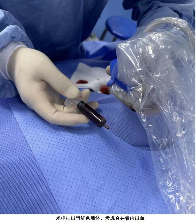 淋巴管瘤微创介入要打麻药吗,淋巴管瘤的微创治疗