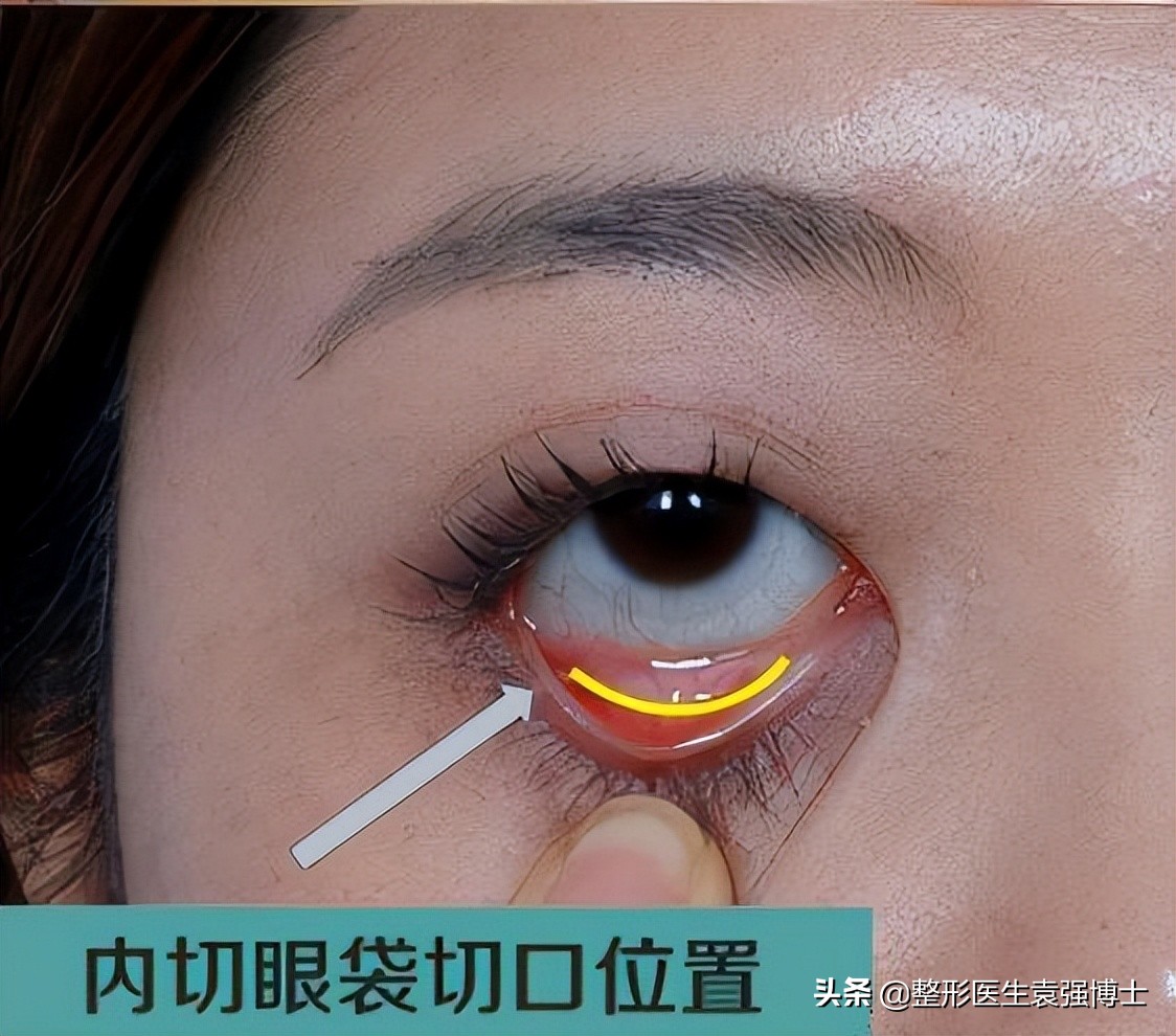 眼周年轻化手术效果可以持续多久,眼周医美项目