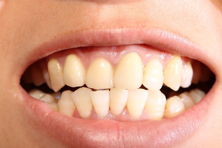 牙龈萎缩的原因及治疗方法,牙龈严重萎缩的解决办法