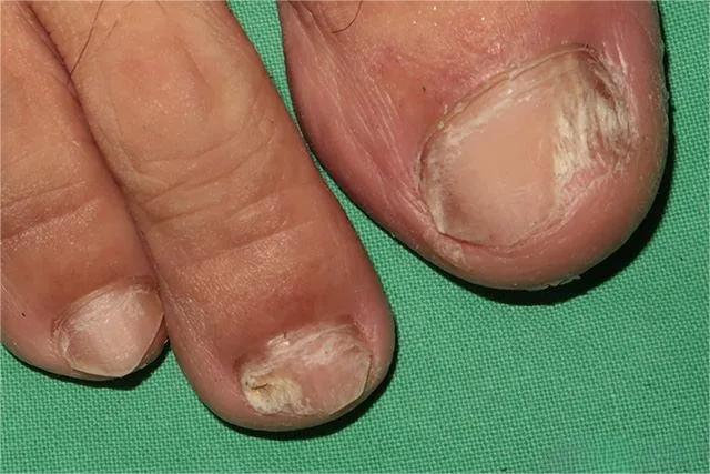 甲癣不严重怎么治疗,甲易生治疗灰指甲吗