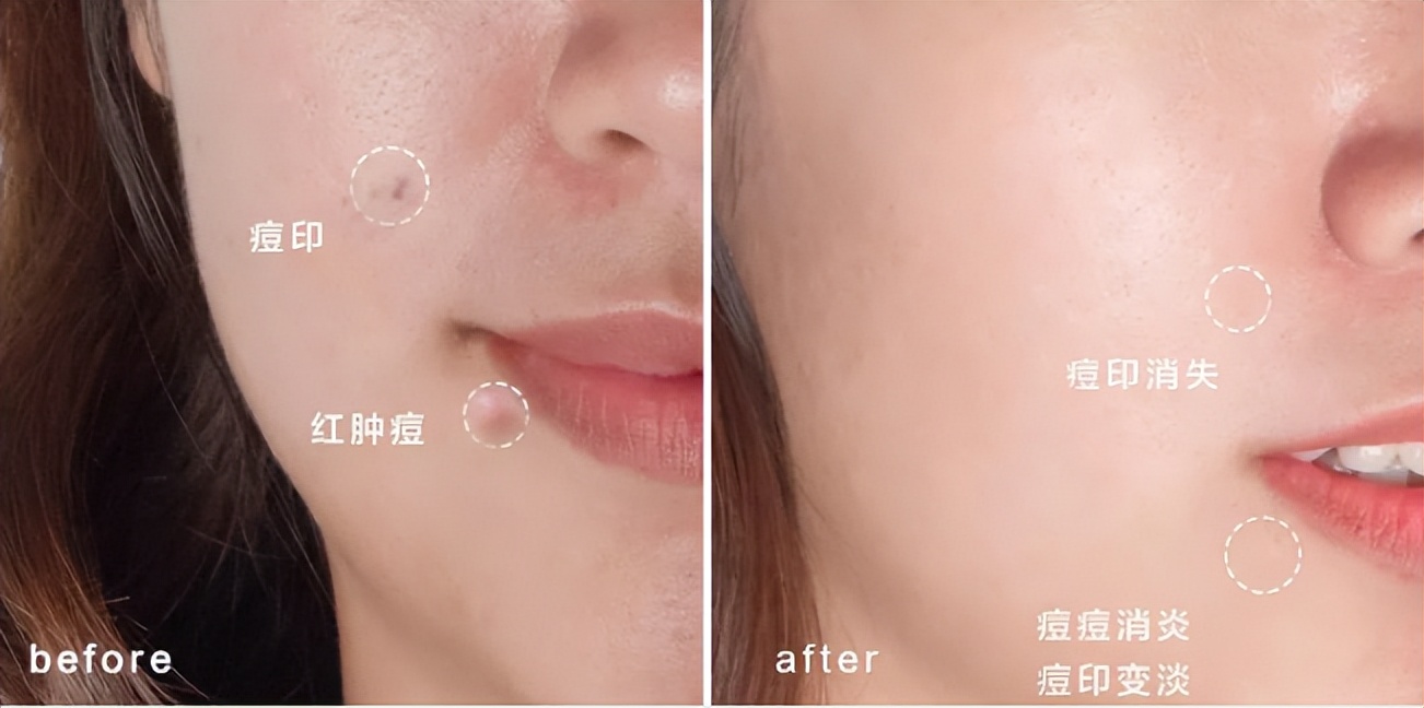 花漾缘面膜,花漾缘祛痘清洁面膜