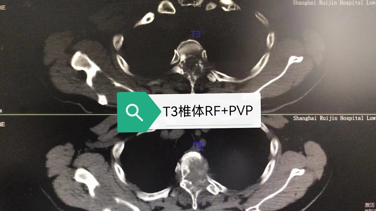 病例Ⅴ：RF+PVP联合治疗高位胸椎溶骨性转移瘤及压缩骨折