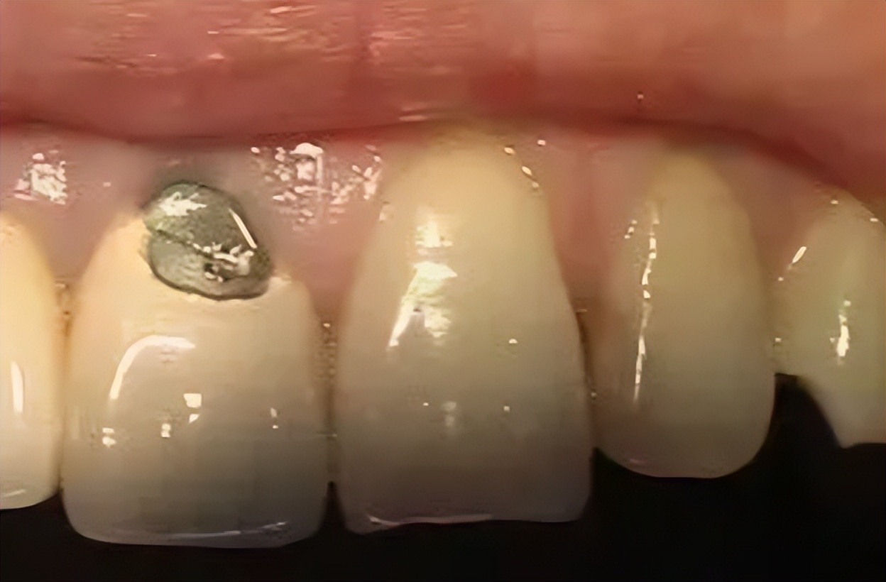 【AISR爱至情报所】假牙吃东西有风险，烤瓷牙裂了该怎么办？