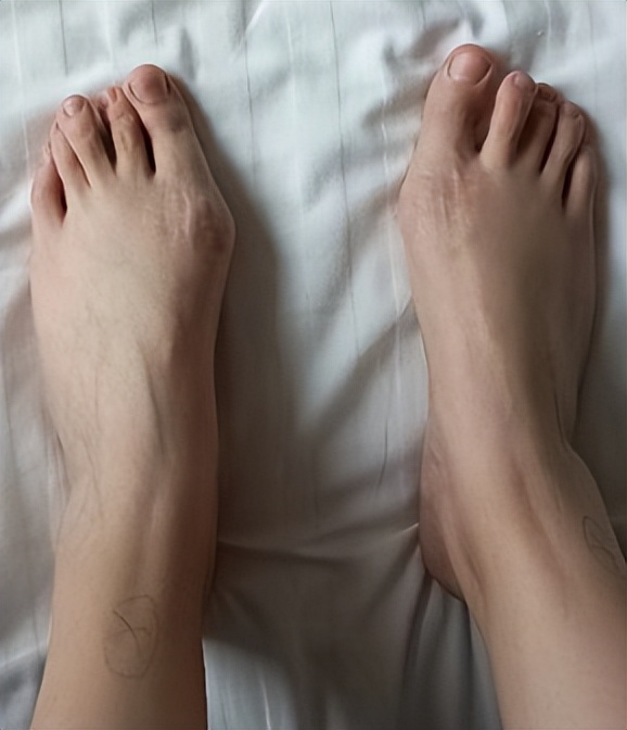 脚趾外翻疼痛怎么治,脚趾外翻肿痛怎么消肿