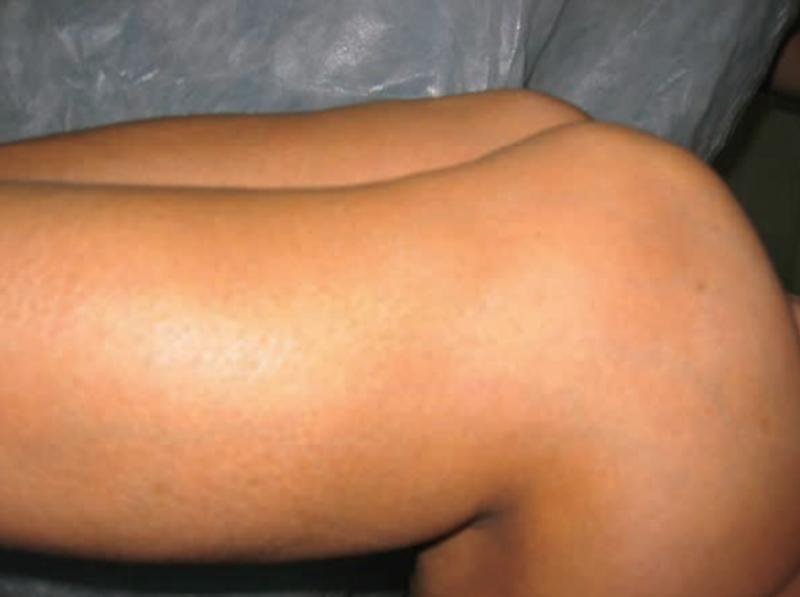 膝关节前交叉韧带损伤怎么治,十字交叉韧带损伤如何解决