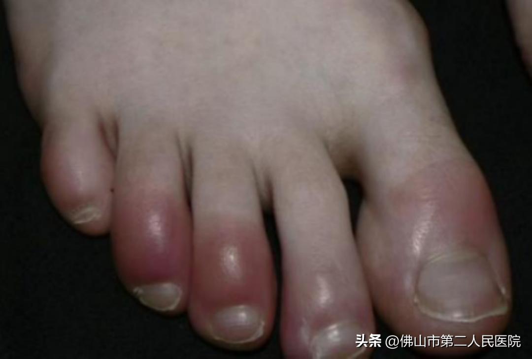 阳过之后皮疹怎么回事,阳了以后皮疹