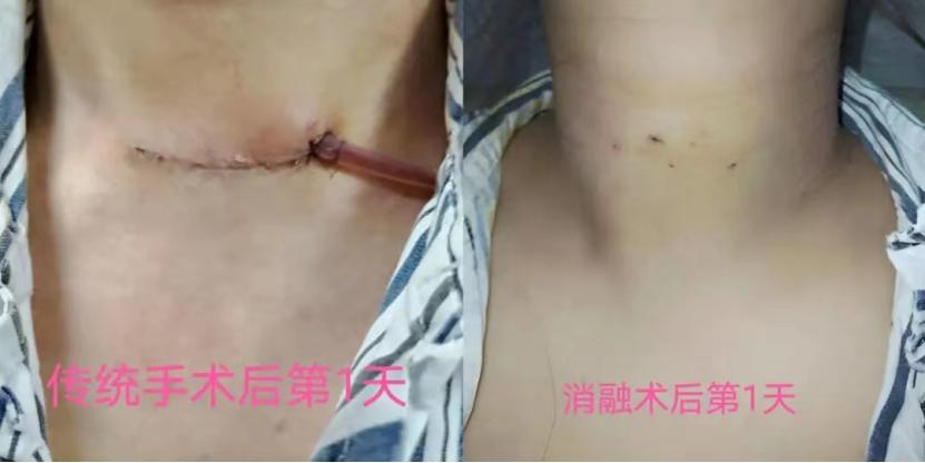 甲状腺囊实性结节微波消融好吗,甲状腺良性结节微波消融术优缺点