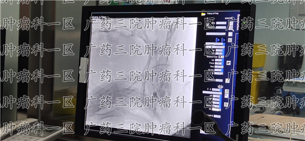 子宫癌放疗能治好吗,子宫癌中期放疗能治好吗