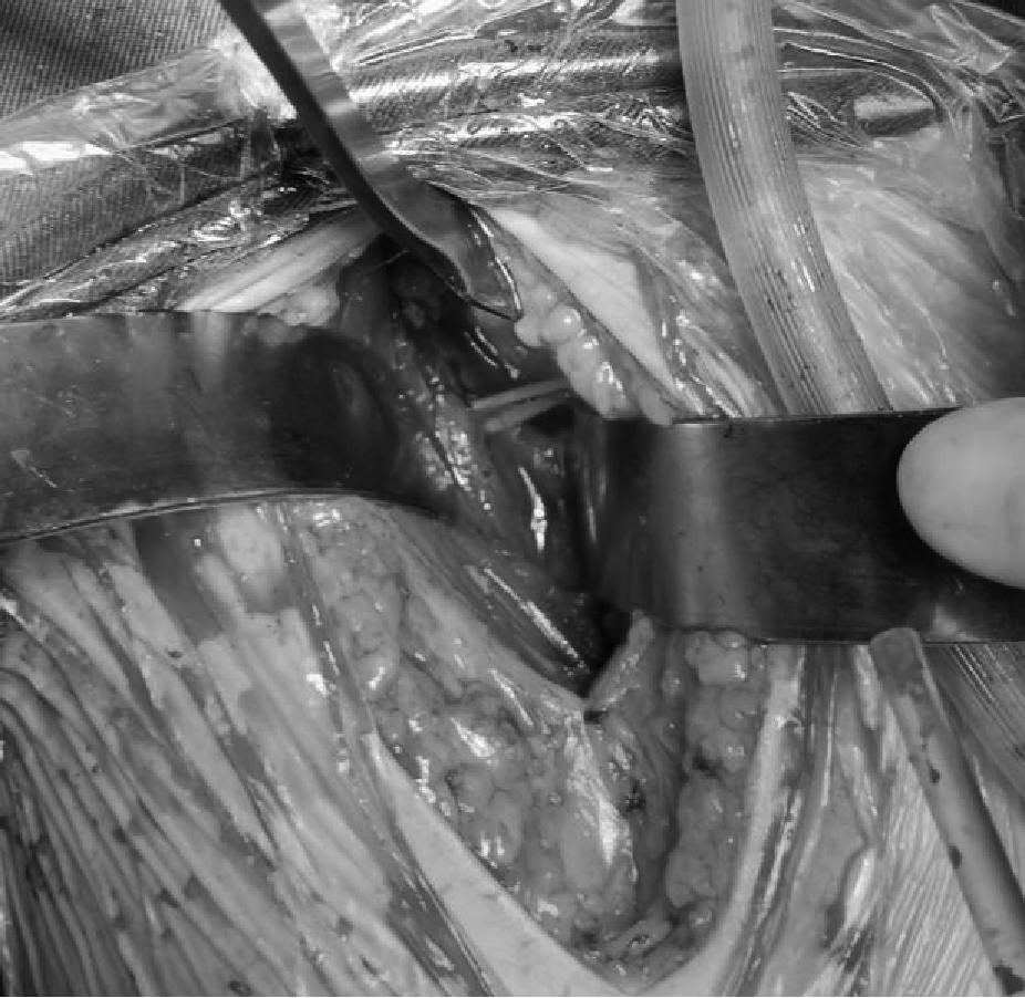 老人股骨头骨折手术,股骨头骨折最佳手术方法