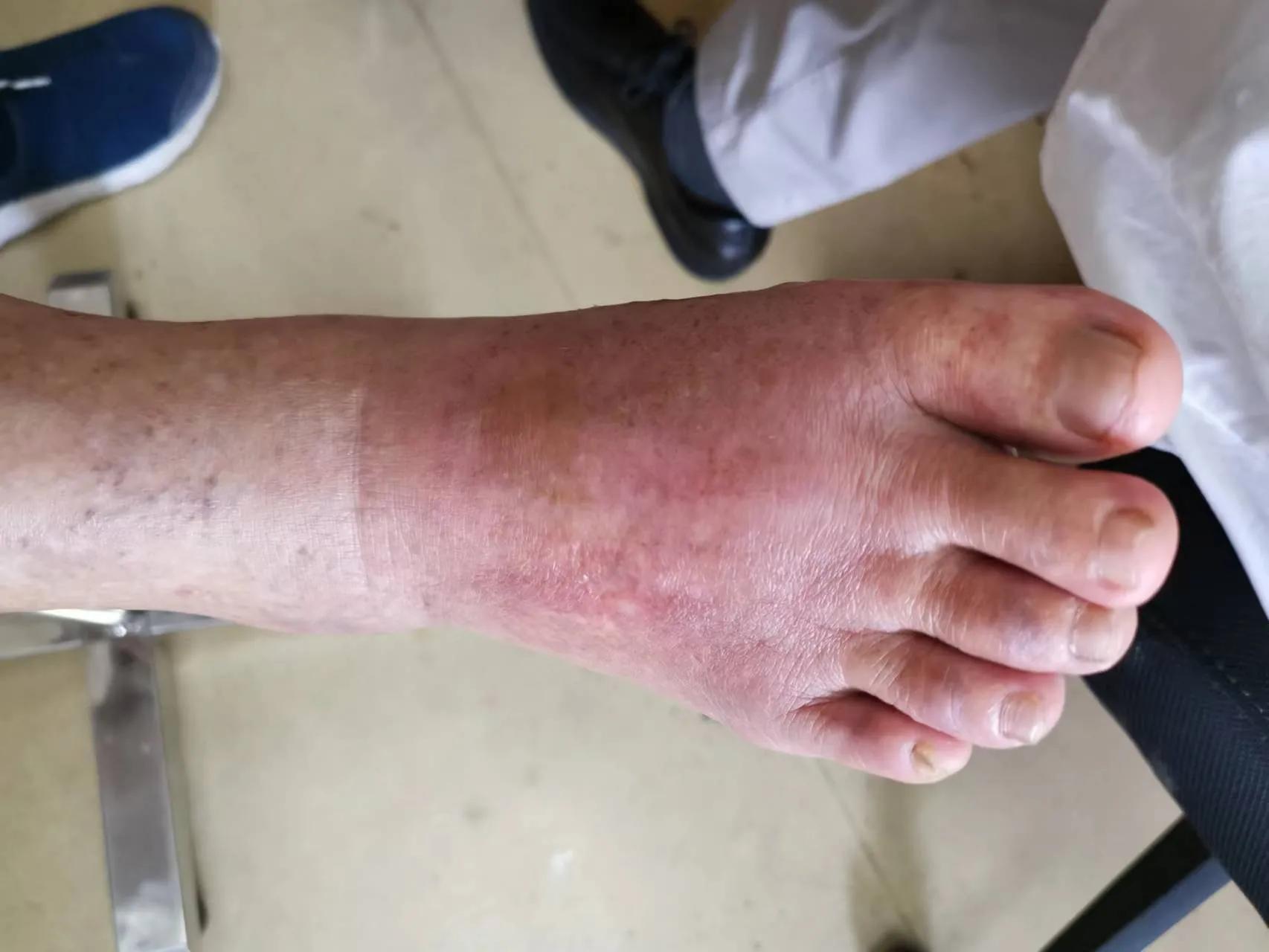 美女教你脚踝扭伤的紧急处理方法,脚踝扭伤肿了怎么处理能快速消肿