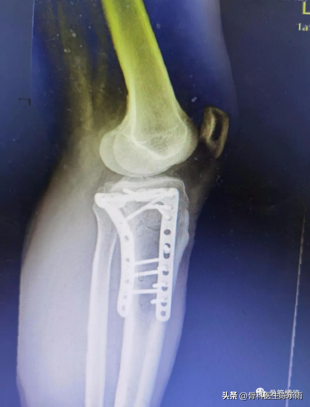 膝关节胫骨平台骨折,最近胫骨平台骨折视频