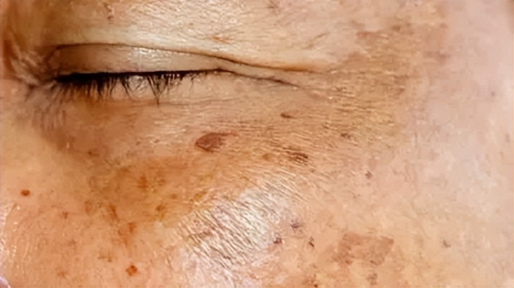 老年斑和色素沉着怎么区分,老年斑和色素沉着怎么治