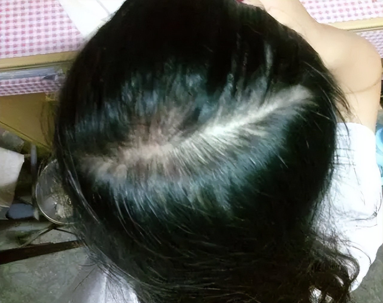 头皮上经常长脓包,头皮经常起疙瘩有脓包是什么原因