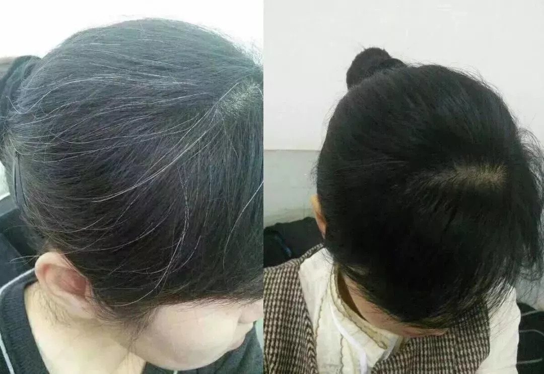 年轻白头发增多是什么原因造成的,年轻时白头发比较多怎么调理