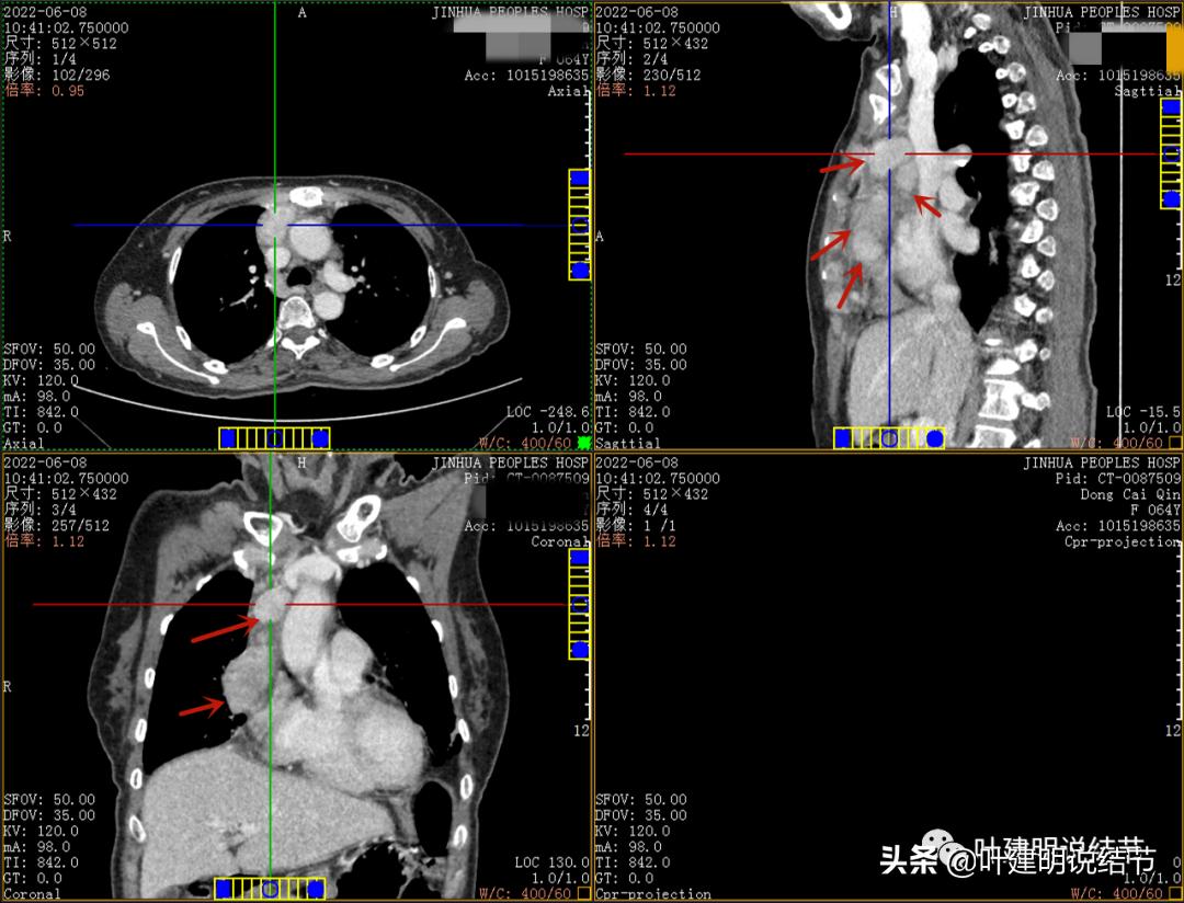 这位老乡，乏力来查，查出这么大个的纵隔肿瘤！会是什么呢？