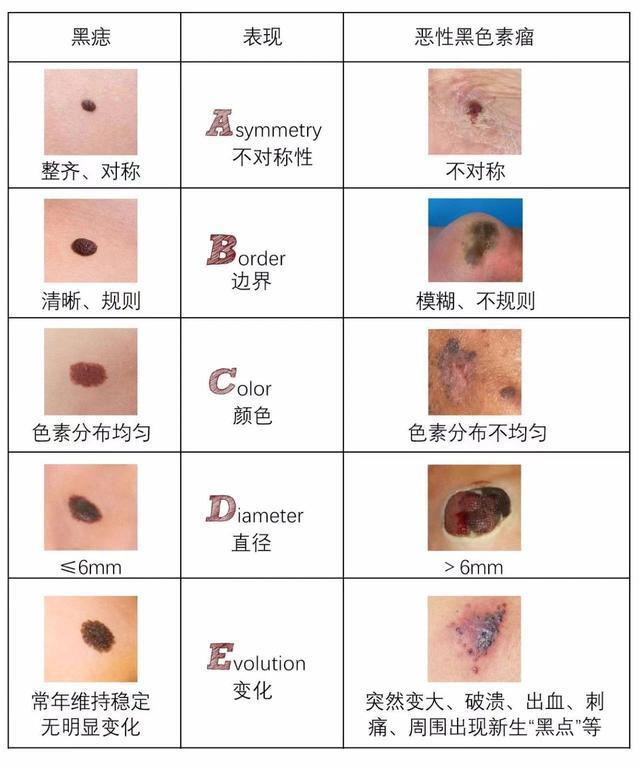 成都市二医院医学美容科,成都市二医院祛痣挂什么科