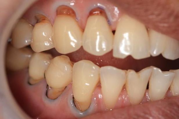 牙齿敏感用什么方法能解决,牙齿敏感快速解决方法