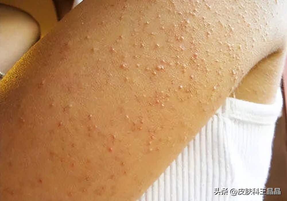 夏季不敢露胳膊,夏天露腿鸡皮肤