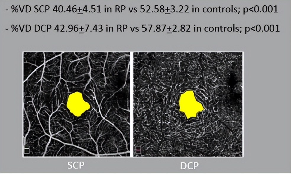 视网膜炎oct的详细图解,视网膜色素变性oct检查