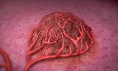 微球治疗肝癌能活多久,90微球治疗肝癌普及了吗