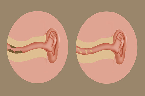 干耳屎会变成油耳朵吗,耳朵每天都有耳屎是干耳还是油耳