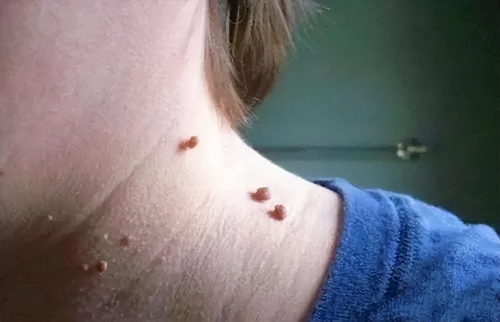 皮肤表面的小肉球是什么,皮肤上的小疙瘩小肉球